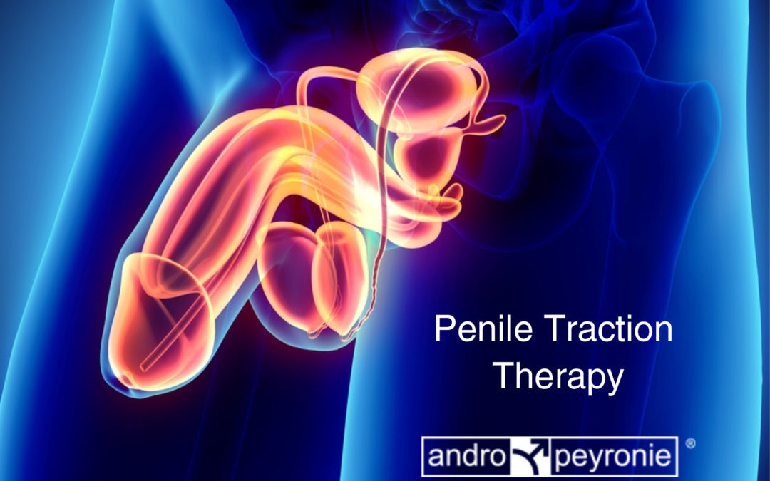Andropeyronie penile traction thetapy extender peyronie's disease
